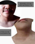 Clear Breakthrough: Blemish Support Trio